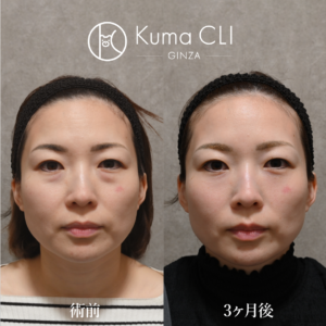 裏evoリフト法＋ナノリッチ